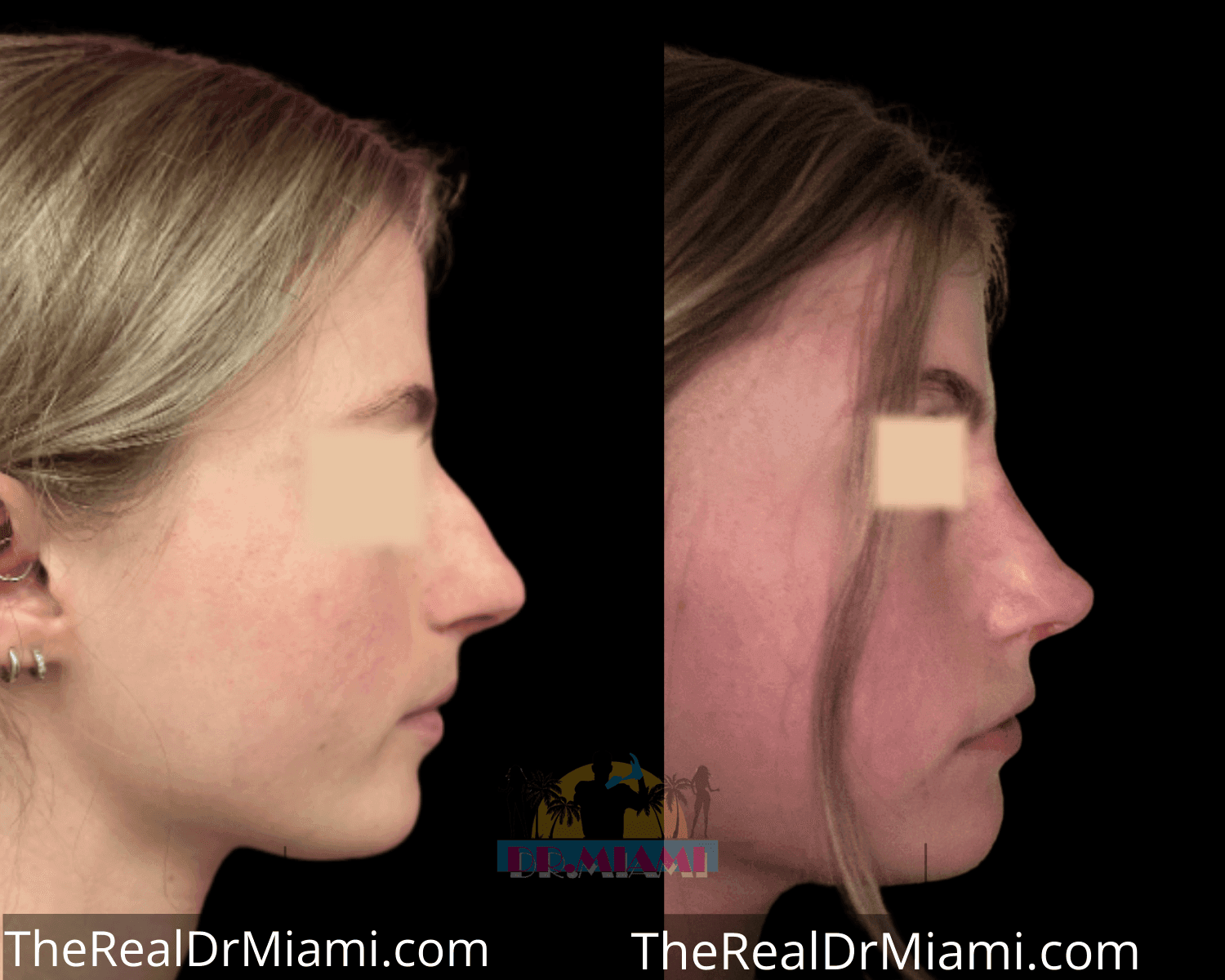 Before-and-after views for Rhinoplasty, Case 44.