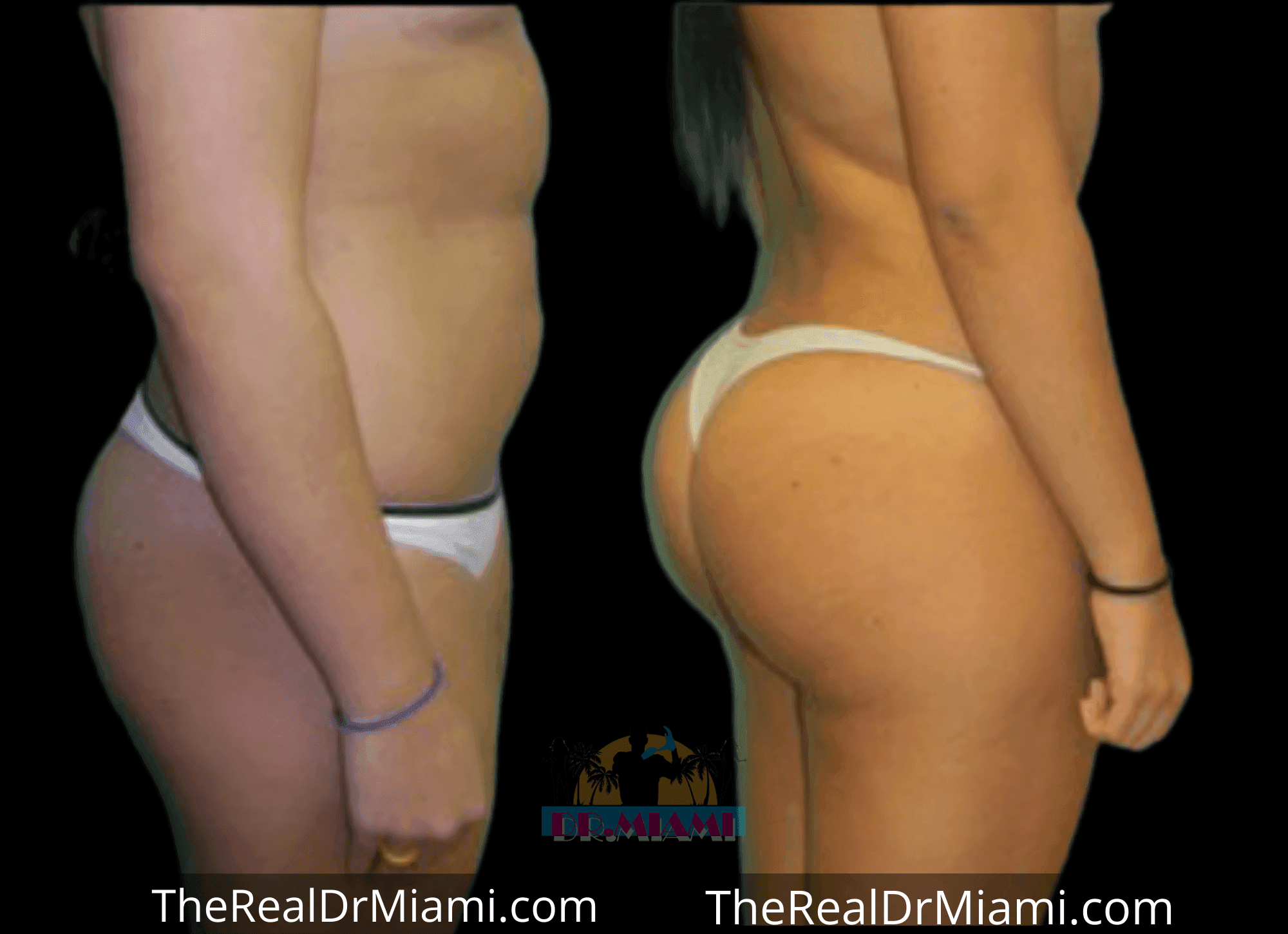 Before-and-after views for Brazilian Butt Lift, Case 10.