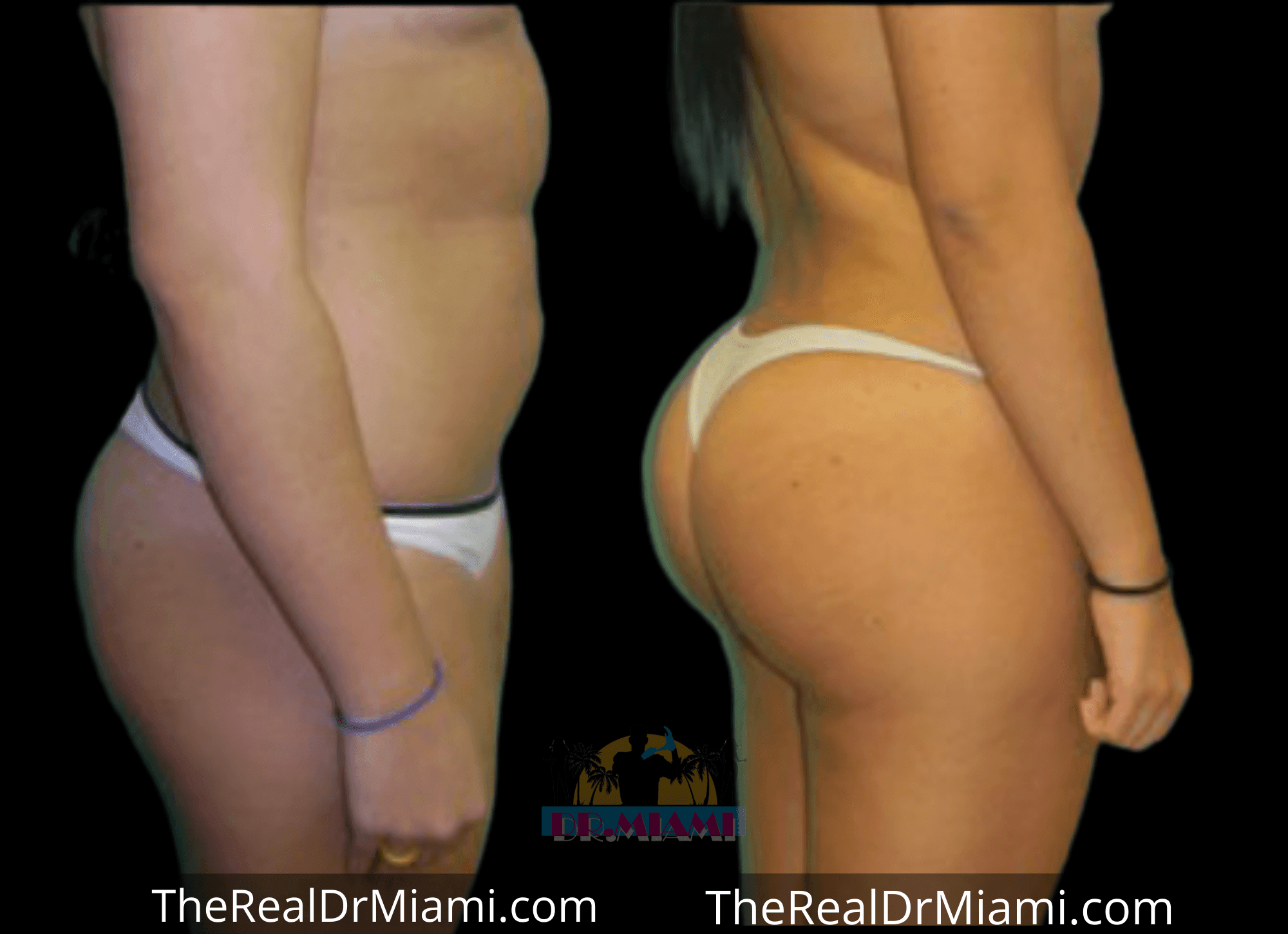 Before-and-after views for Brazilian Butt Lift, Case 10.