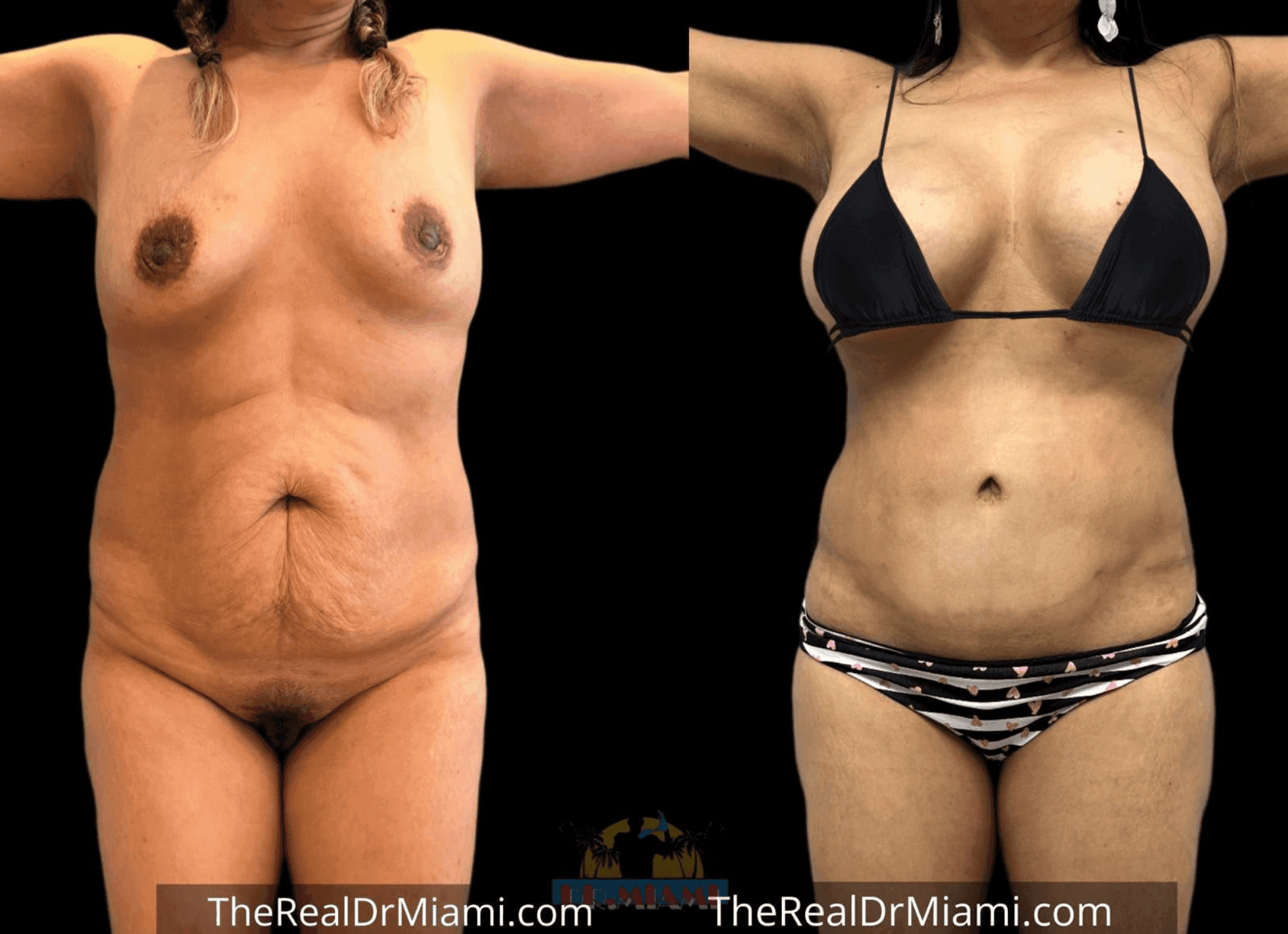 Before-and-after views for Mommy Makeover, Case 21.