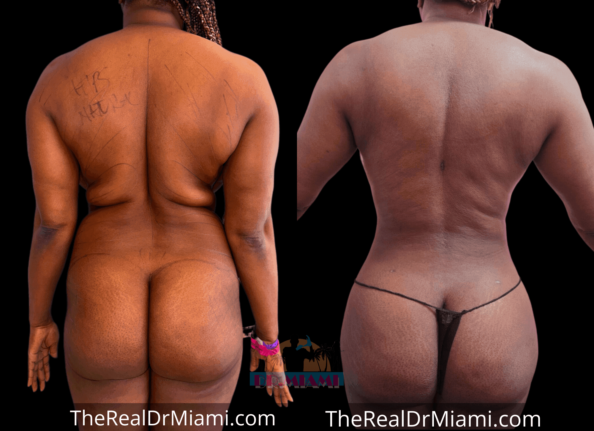 Before-and-after views for Brazilian Butt Lift, Case 77.