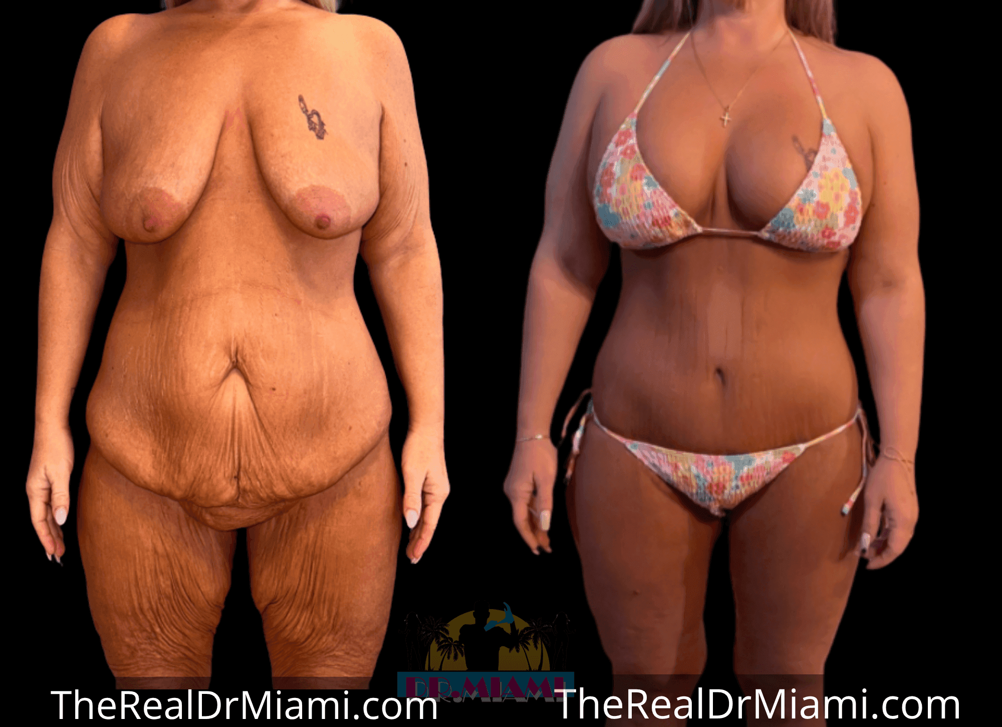 Before-and-after views for Massive Weight Loss, Case 8.