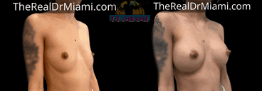 Before-and-after views for Breast Augmentation, Case 81.