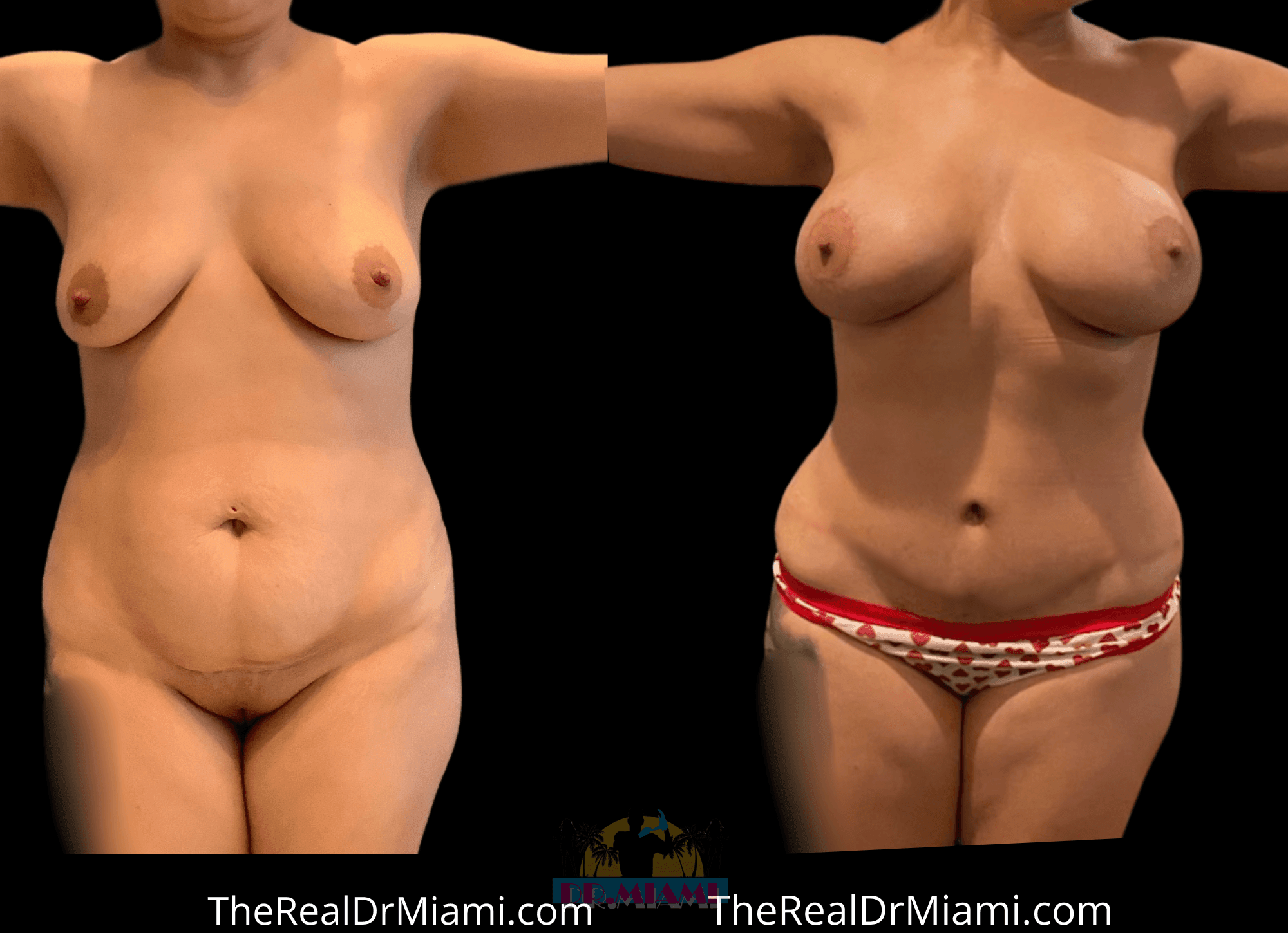 Before-and-after views for Mommy Makeover, Case 19.
