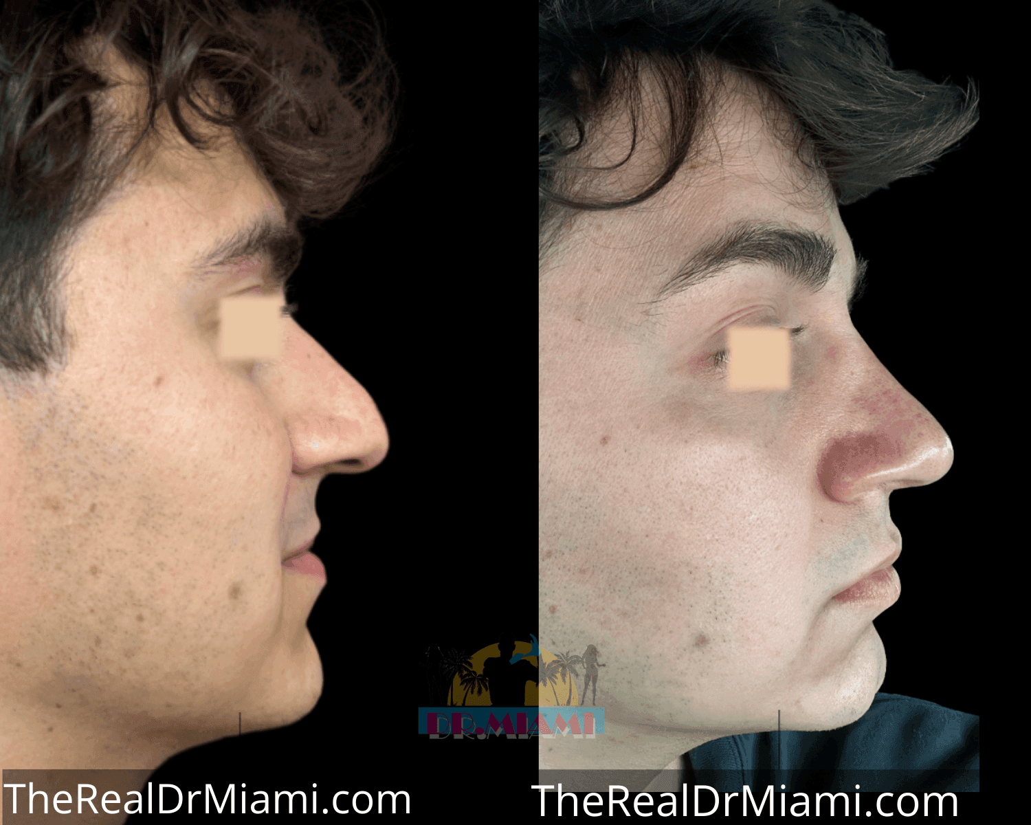 Before-and-after views for Rhinoplasty, Case 56.