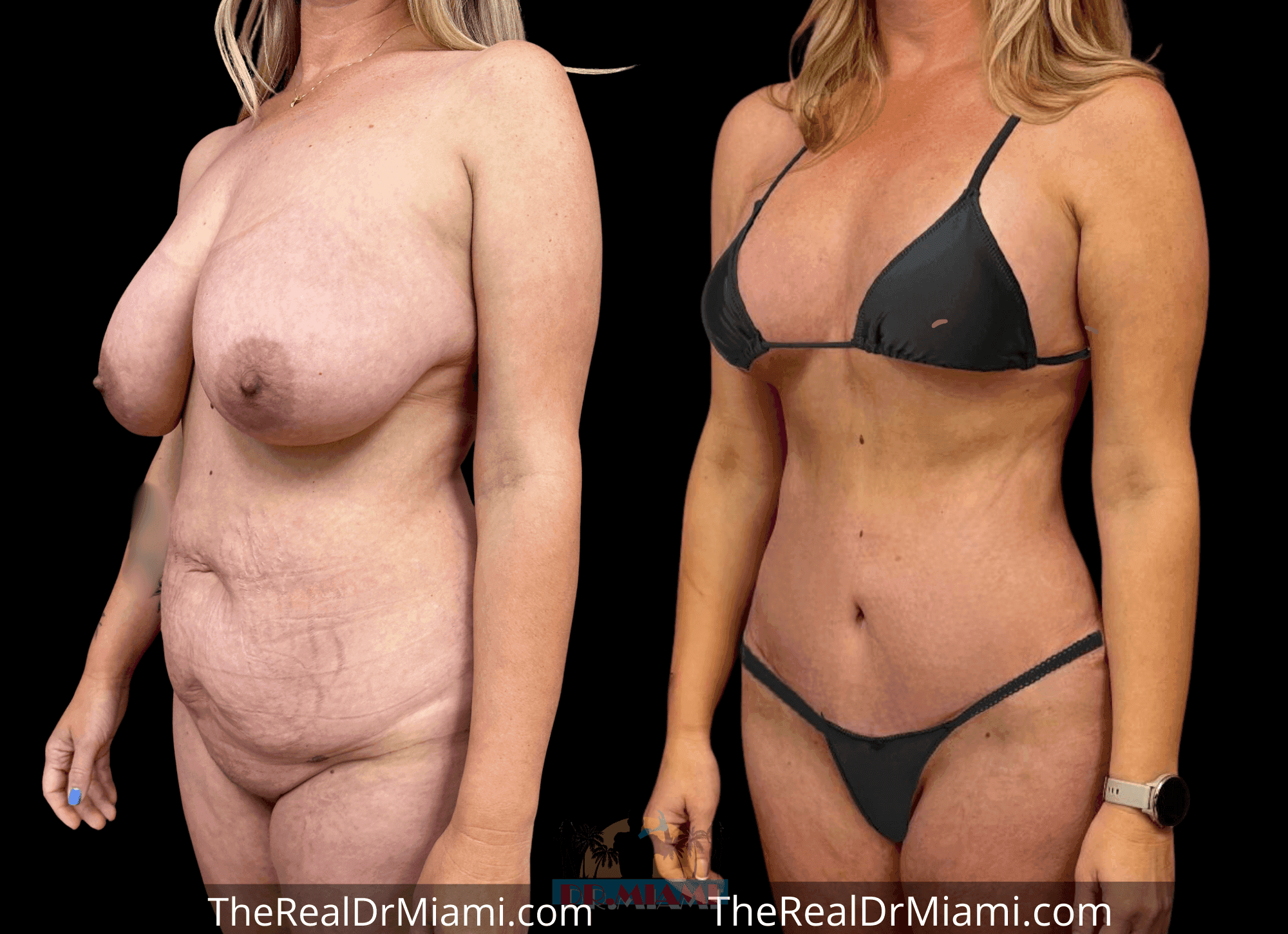 Before-and-after views for Mommy Makeover, Case 119.