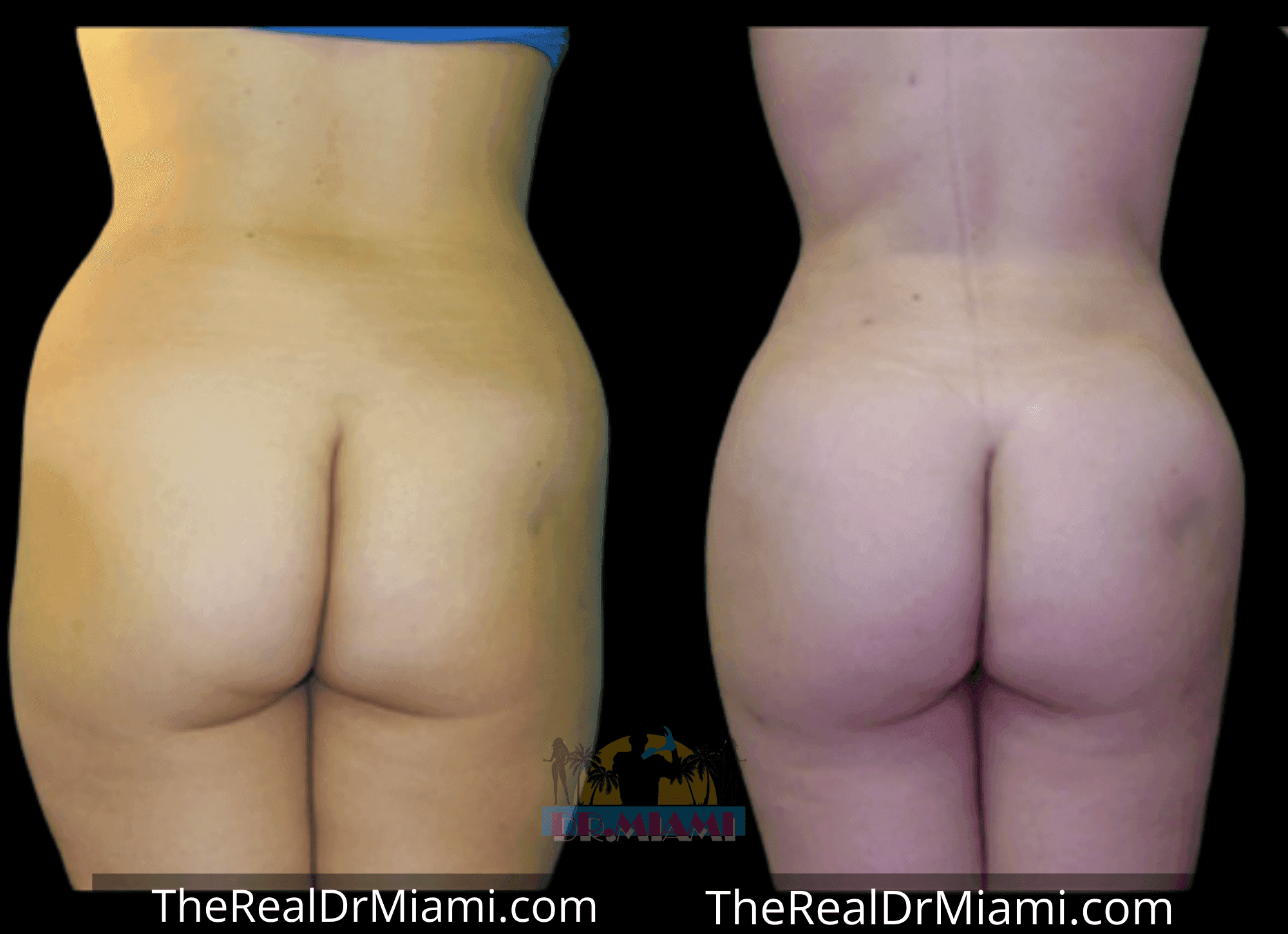 Before-and-after views for Brazilian Butt Lift, Case 70.