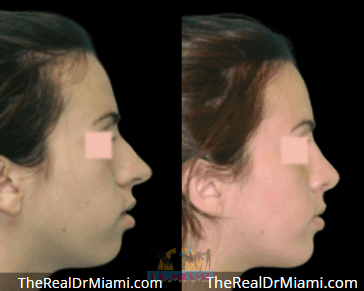 Before-and-after views for Rhinoplasty, Case 70.