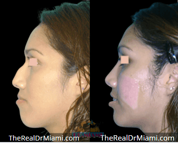 Before-and-after views for Rhinoplasty, Case 82.