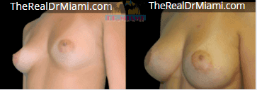 Before-and-after views for Breast Augmentation, Case 30.