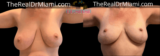 Before-and-after views for Breast Lift, Case 66.