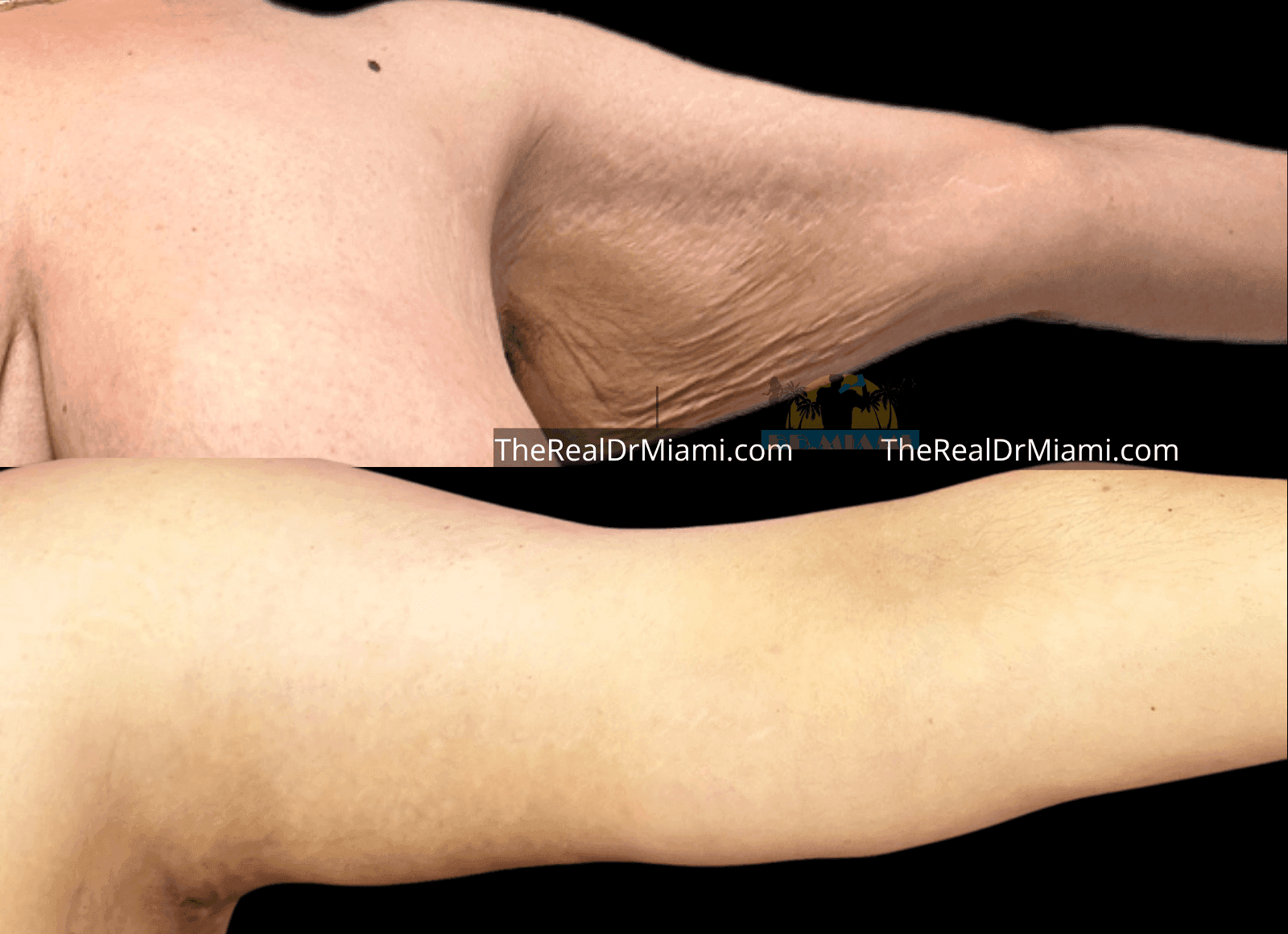 Before-and-after views for Upper Arm Lift, Case 4.