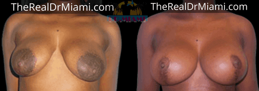 Before-and-after views for Breast Lift, Case 16.