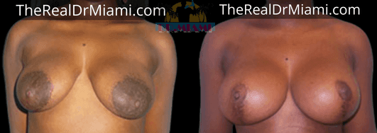 Before-and-after views for Breast Lift, Case 16.
