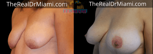 Before-and-after views for Breast Lift, Case 18.