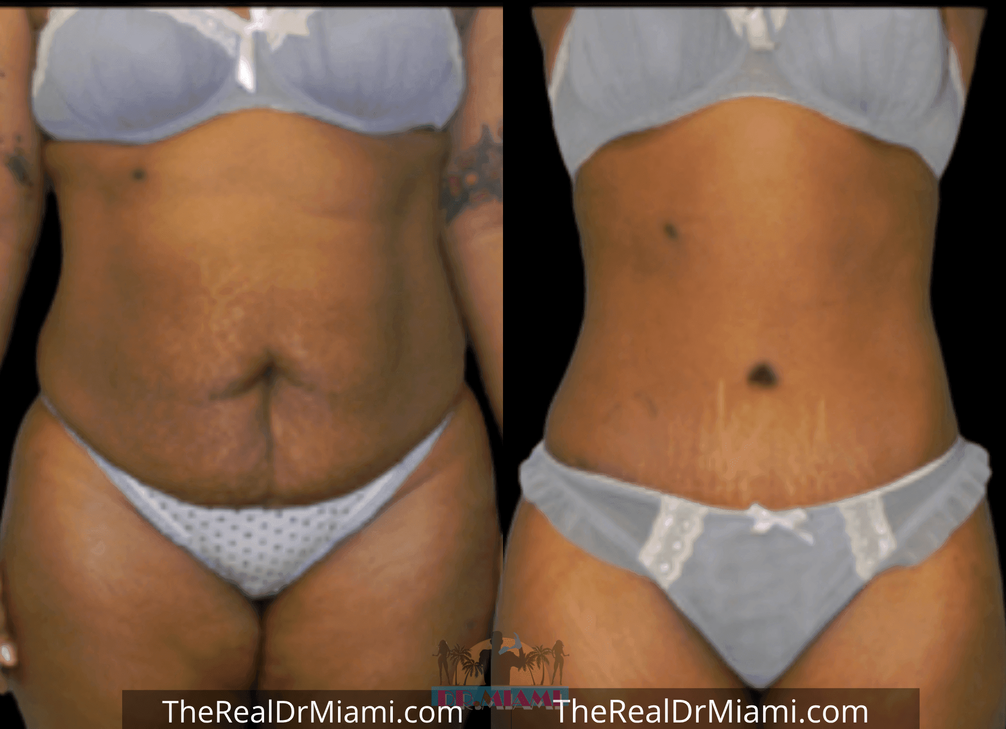 Before-and-after views for Tummy Tuck, Case 92.