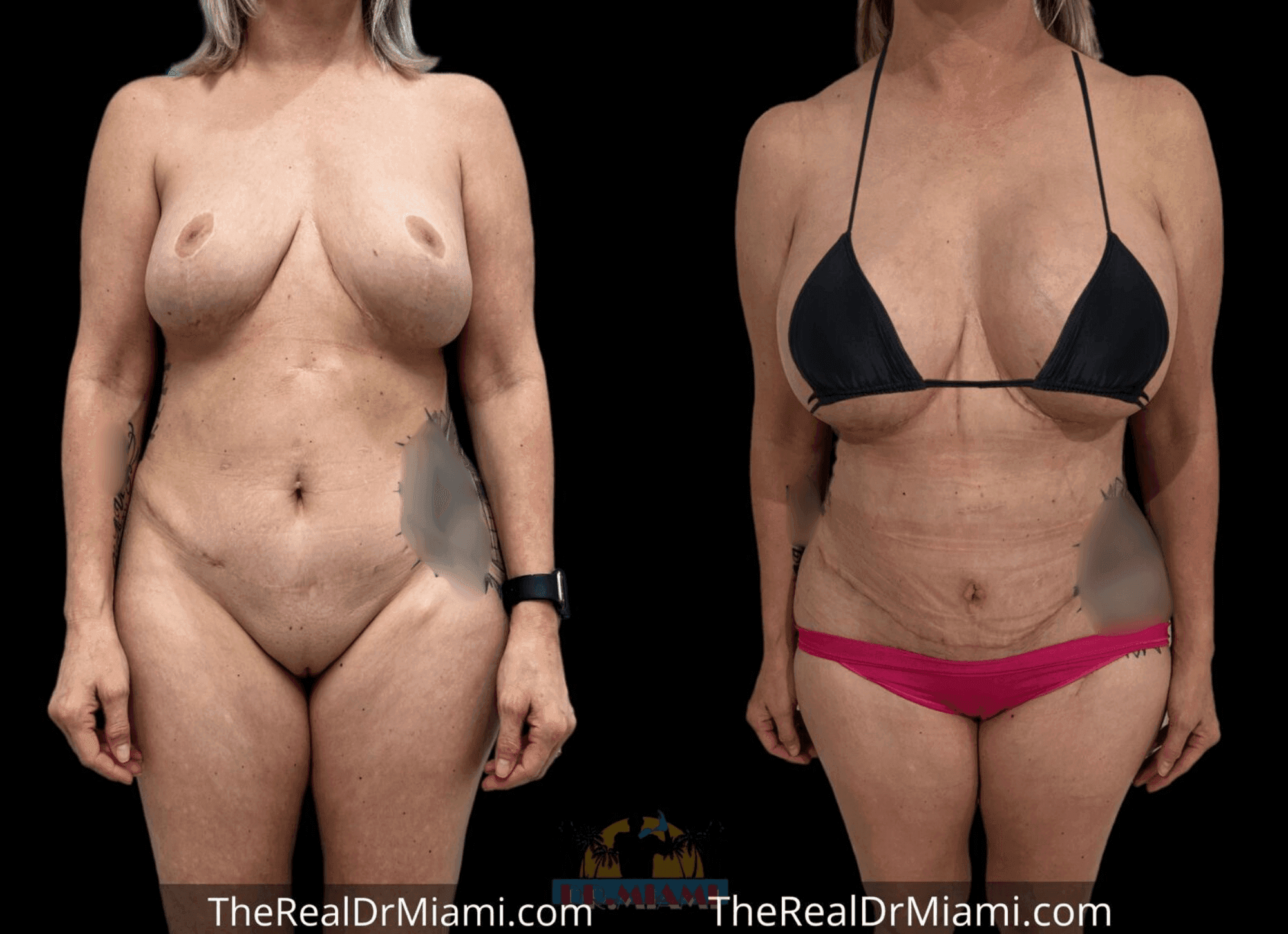 Before-and-after views for Mommy Makeover, Case 15.