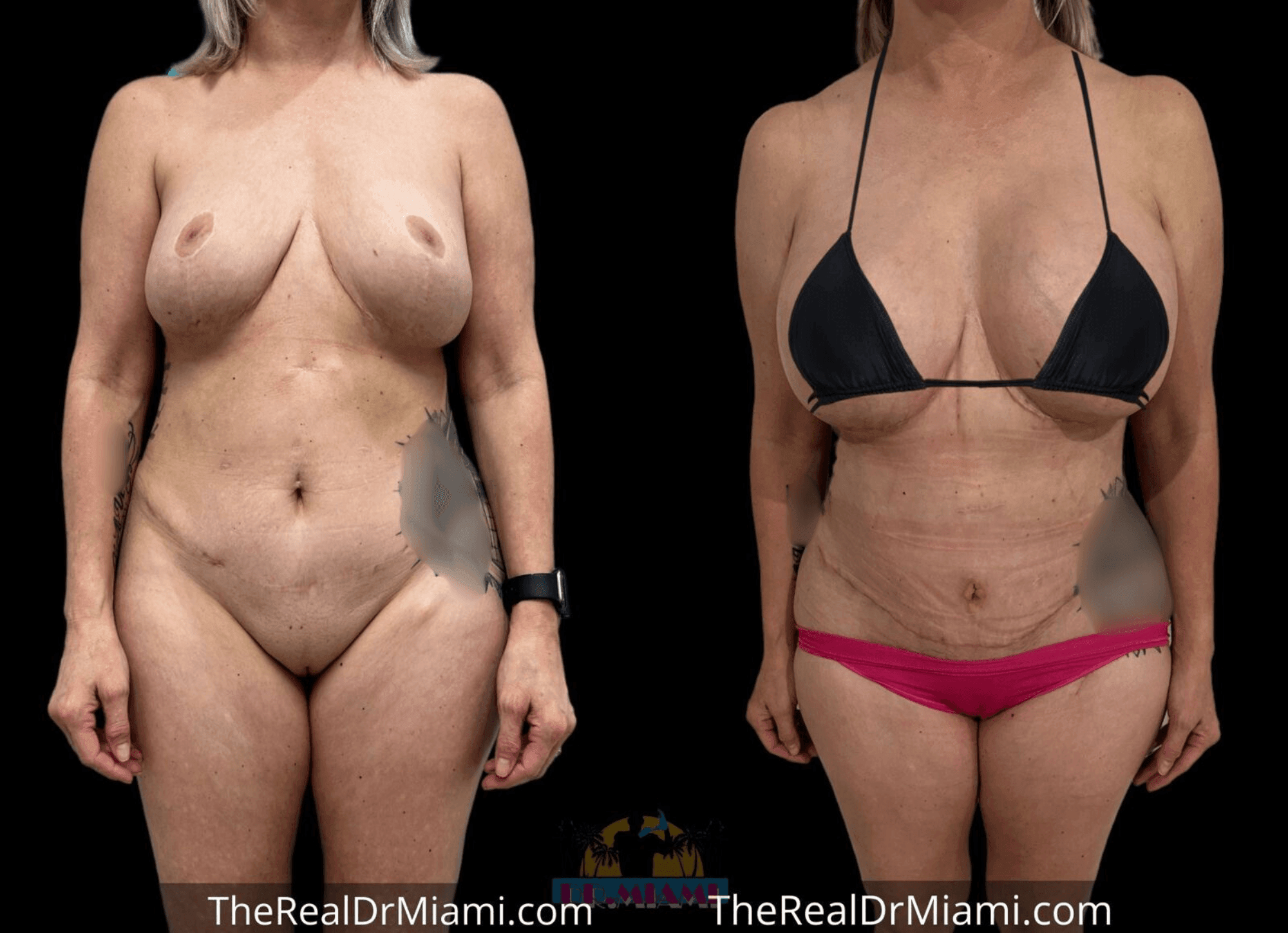 Before-and-after views for Mommy Makeover, Case 15.
