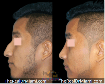Before-and-after views for Rhinoplasty, Case 77.