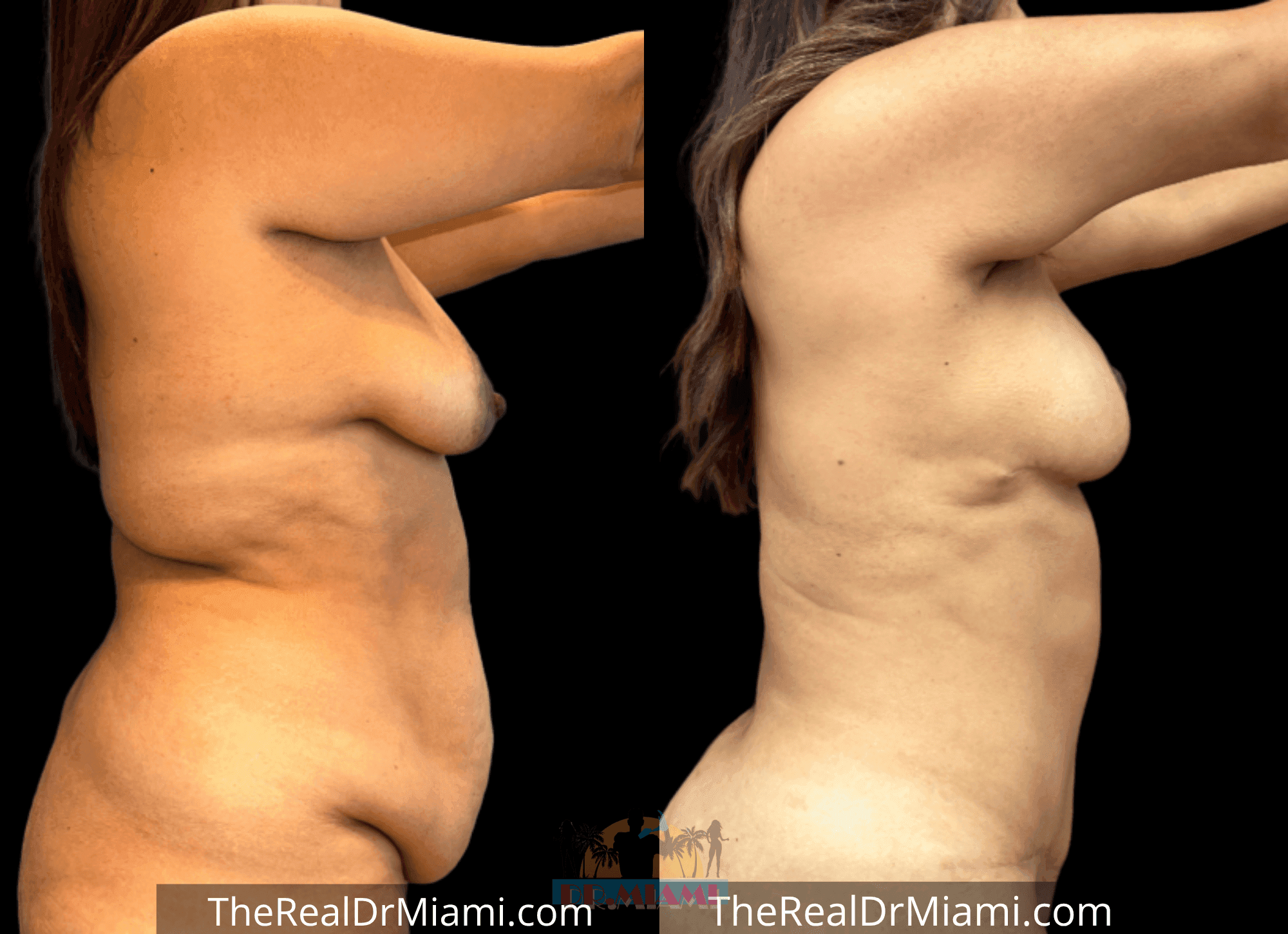 Before-and-after views for Tummy Tuck, Case 30.