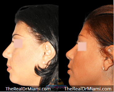 Before-and-after views for Rhinoplasty, Case 97.