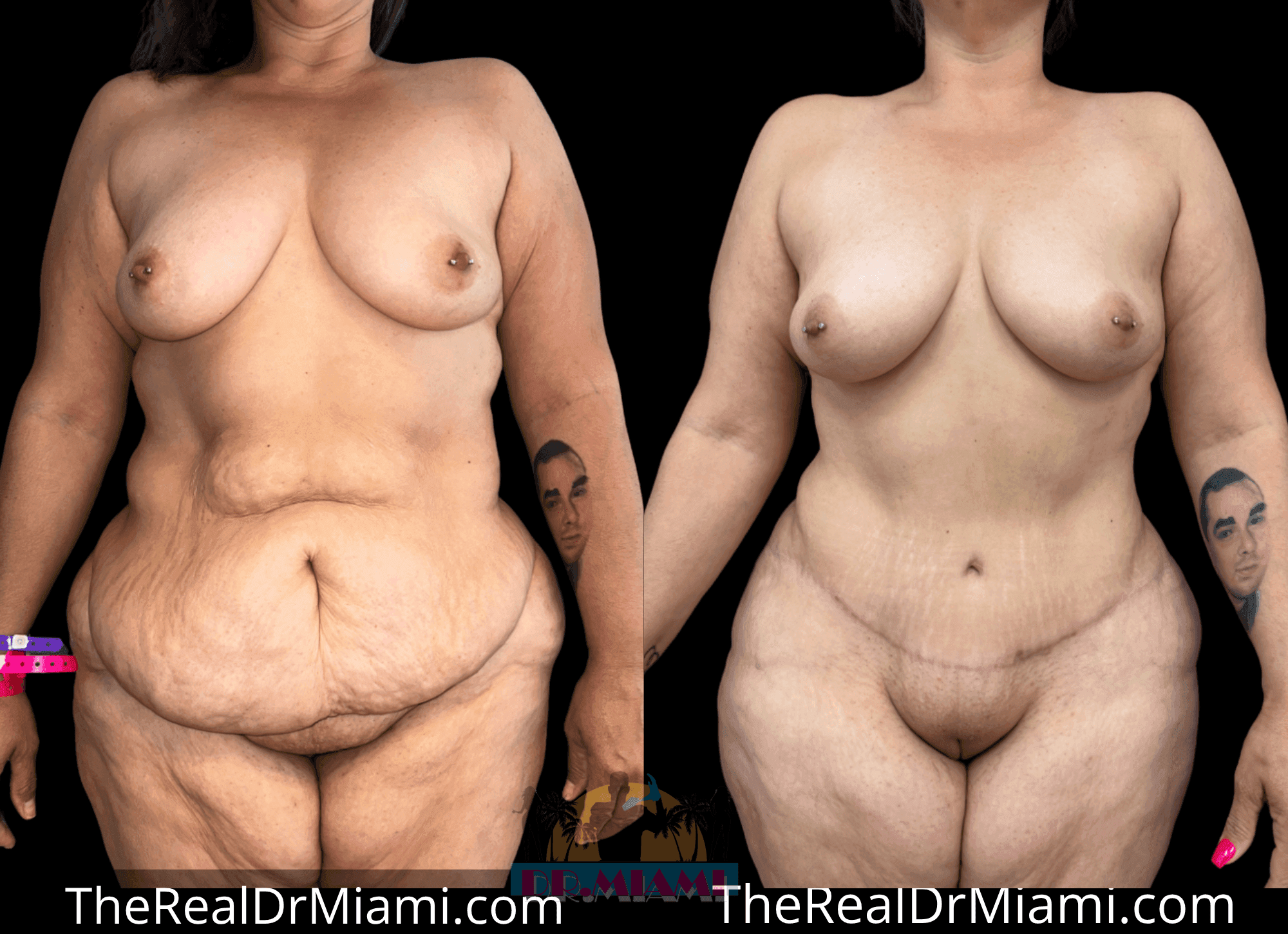 Before-and-after views for Massive Weight Loss, Case 9.