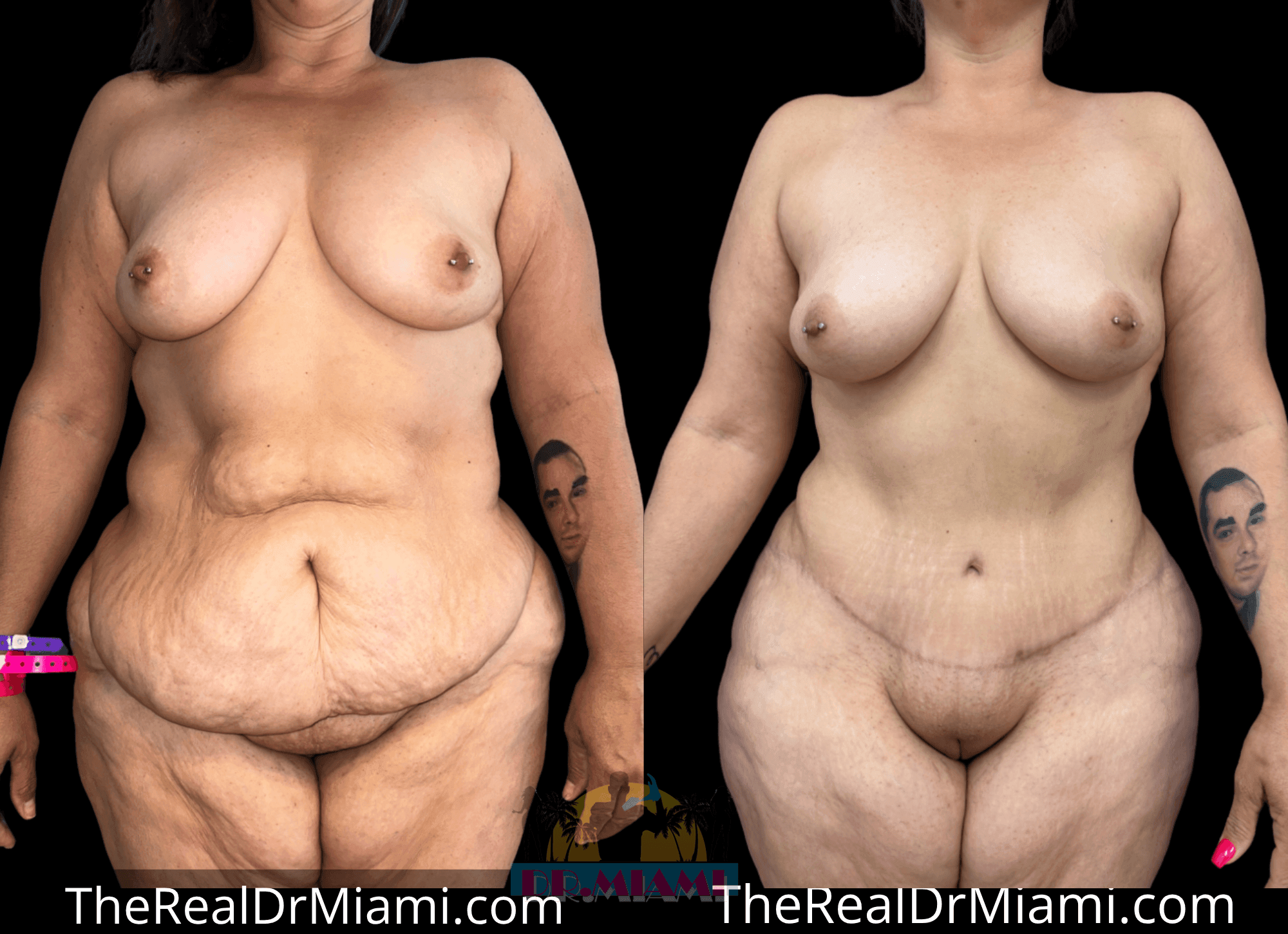 Before-and-after views for Massive Weight Loss, Case 9.