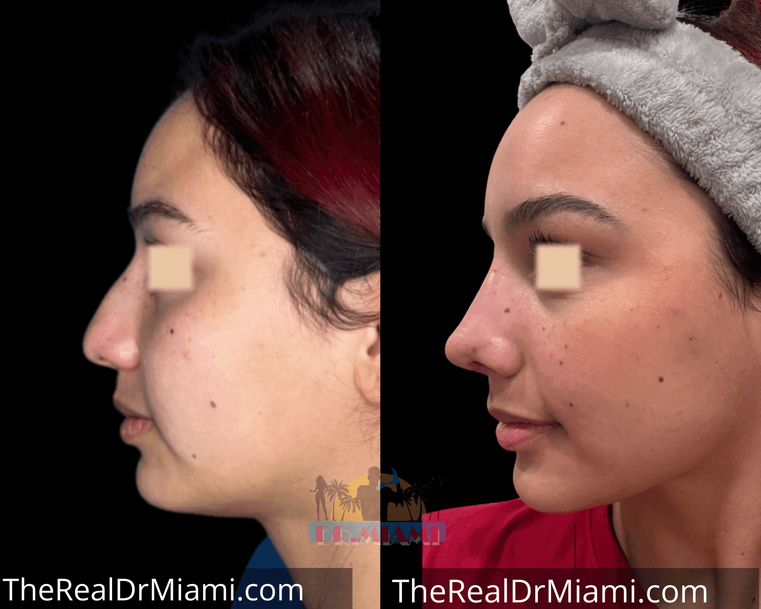 Before-and-after views for Rhinoplasty, Case 36.