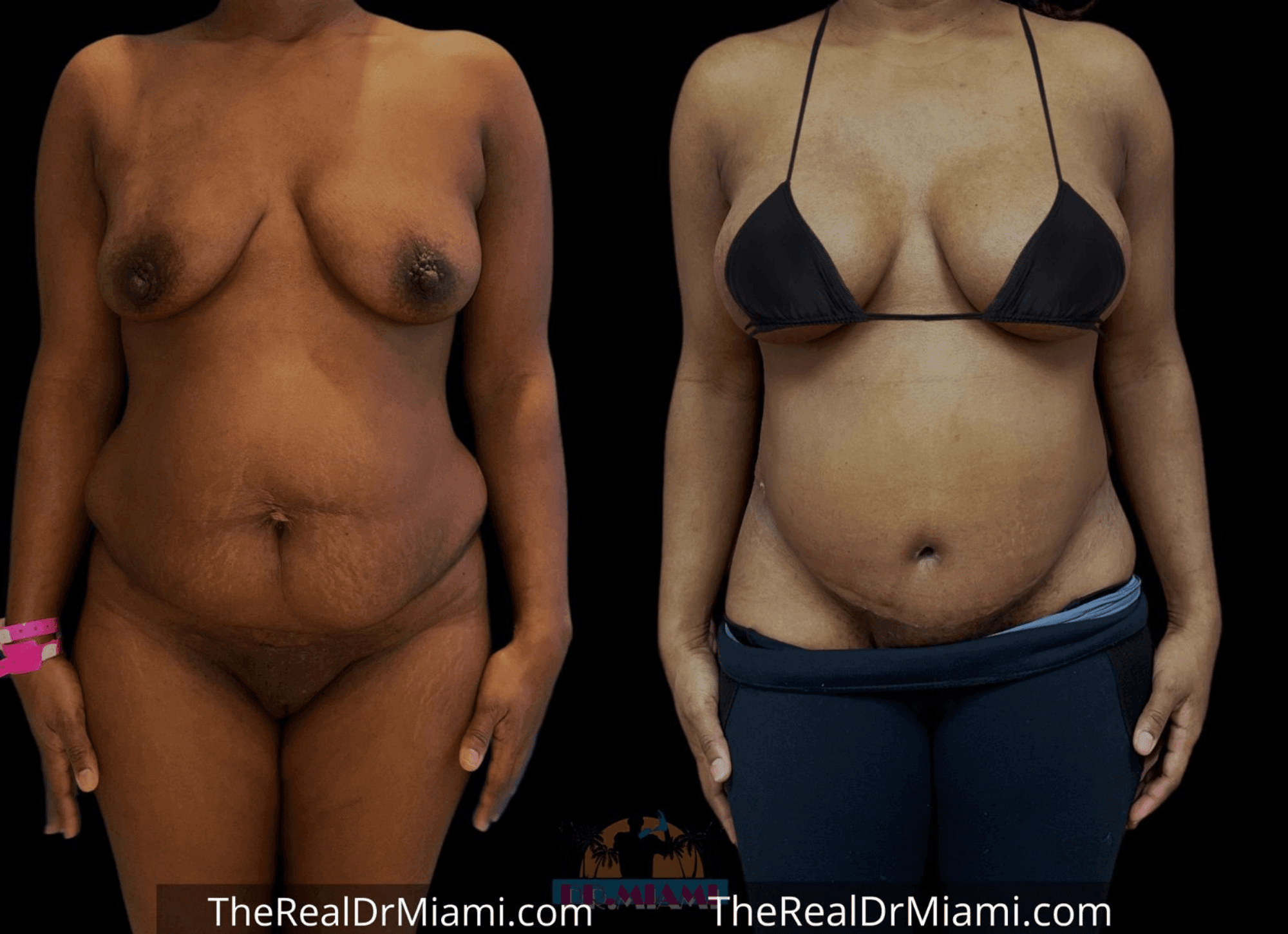 Before-and-after views for Mommy Makeover, Case 23.