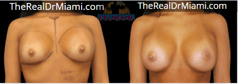Before-and-after views for Breast Augmentation, Case 97.
