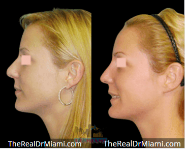 Before-and-after views for Rhinoplasty, Case 91.