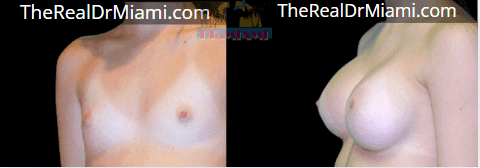 Before-and-after views for Breast Augmentation, Case 107.