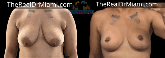 Before-and-after views for Breast Lift, Case 64.