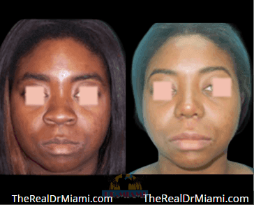 Before-and-after views for Rhinoplasty, Case 65.