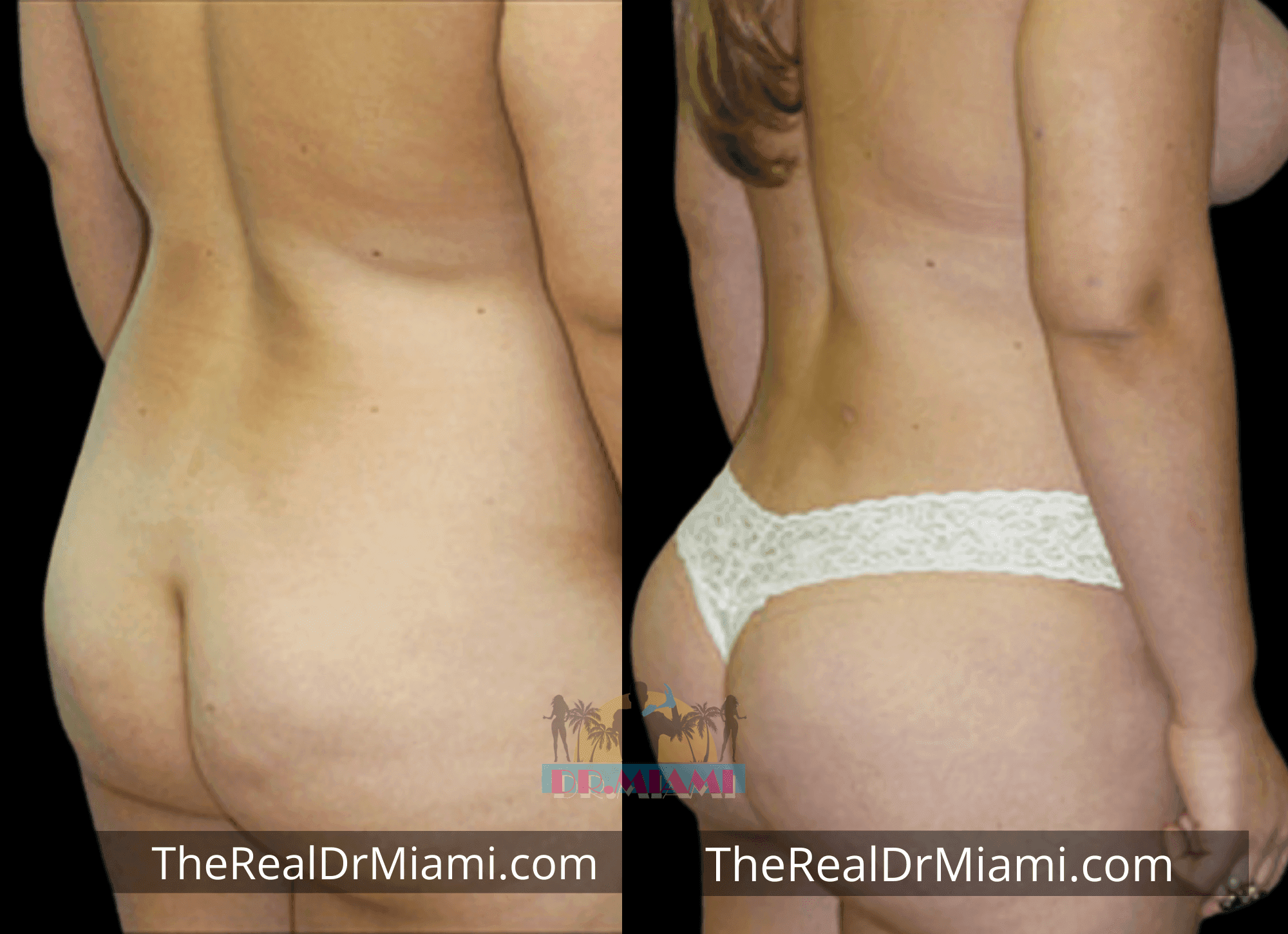 Before-and-after views for Brazilian Butt Lift, Case 69.