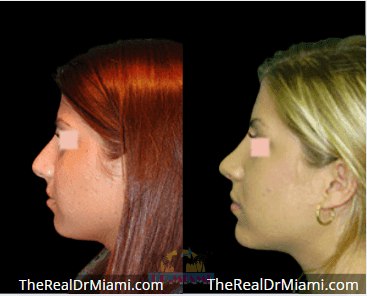 Before-and-after views for Rhinoplasty, Case 95.