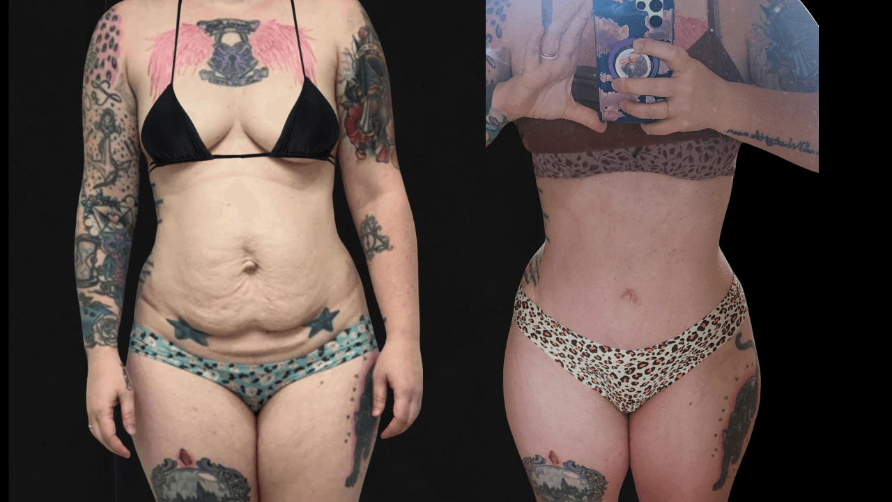 Before-and-after views for Tummy Tuck, Case 5 from The Next Dr. Miami collection.