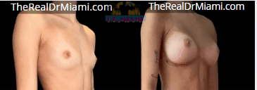 Before-and-after views for Breast Augmentation, Case 6.