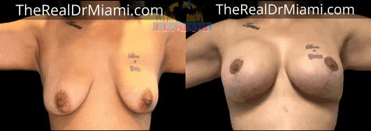 Before-and-after views for Breast Lift, Case 65.