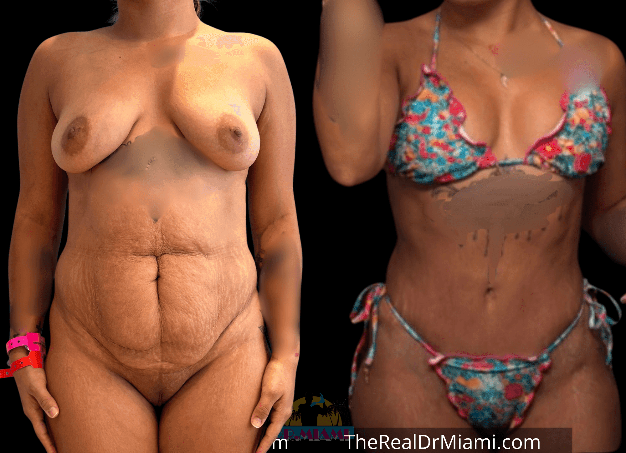 Before-and-after views for Mommy Makeover, Case 112.