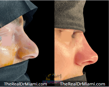 Before-and-after views for Rhinoplasty, Case 124.