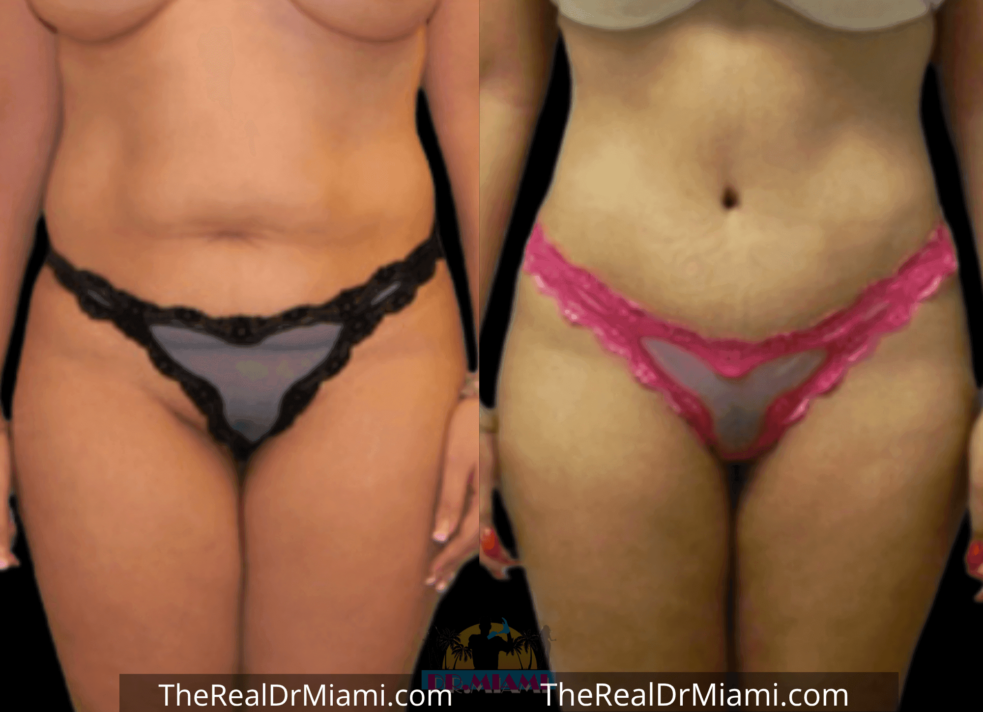 Before-and-after views for Tummy Tuck, Case 64.