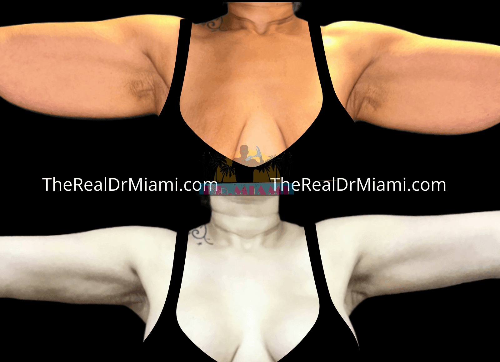 Before-and-after views for Upper Arm Lift, Case 2.