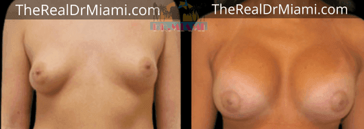 Before-and-after views for Breast Lift, Case 27.