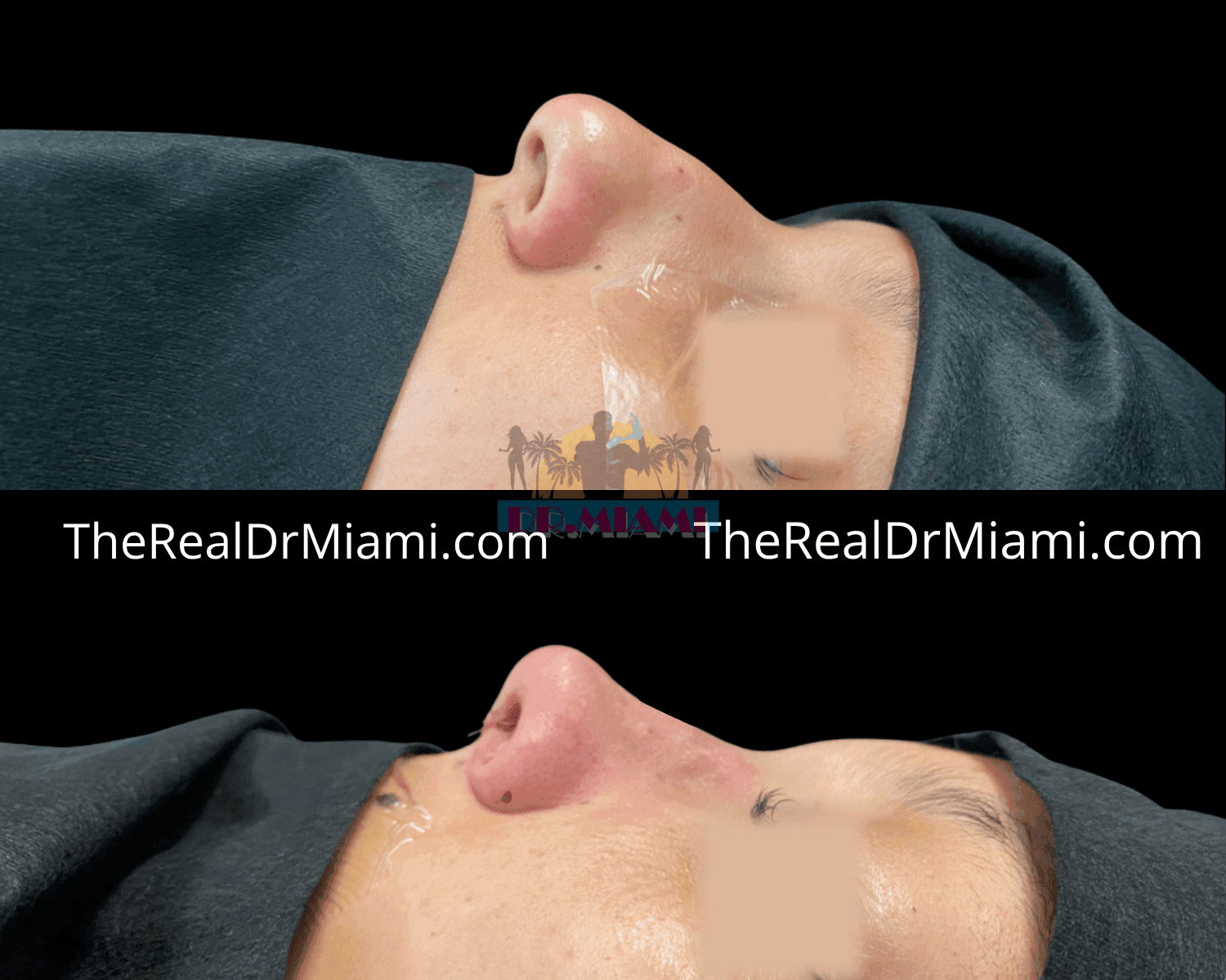 Before-and-after views for Rhinoplasty, Case 13.