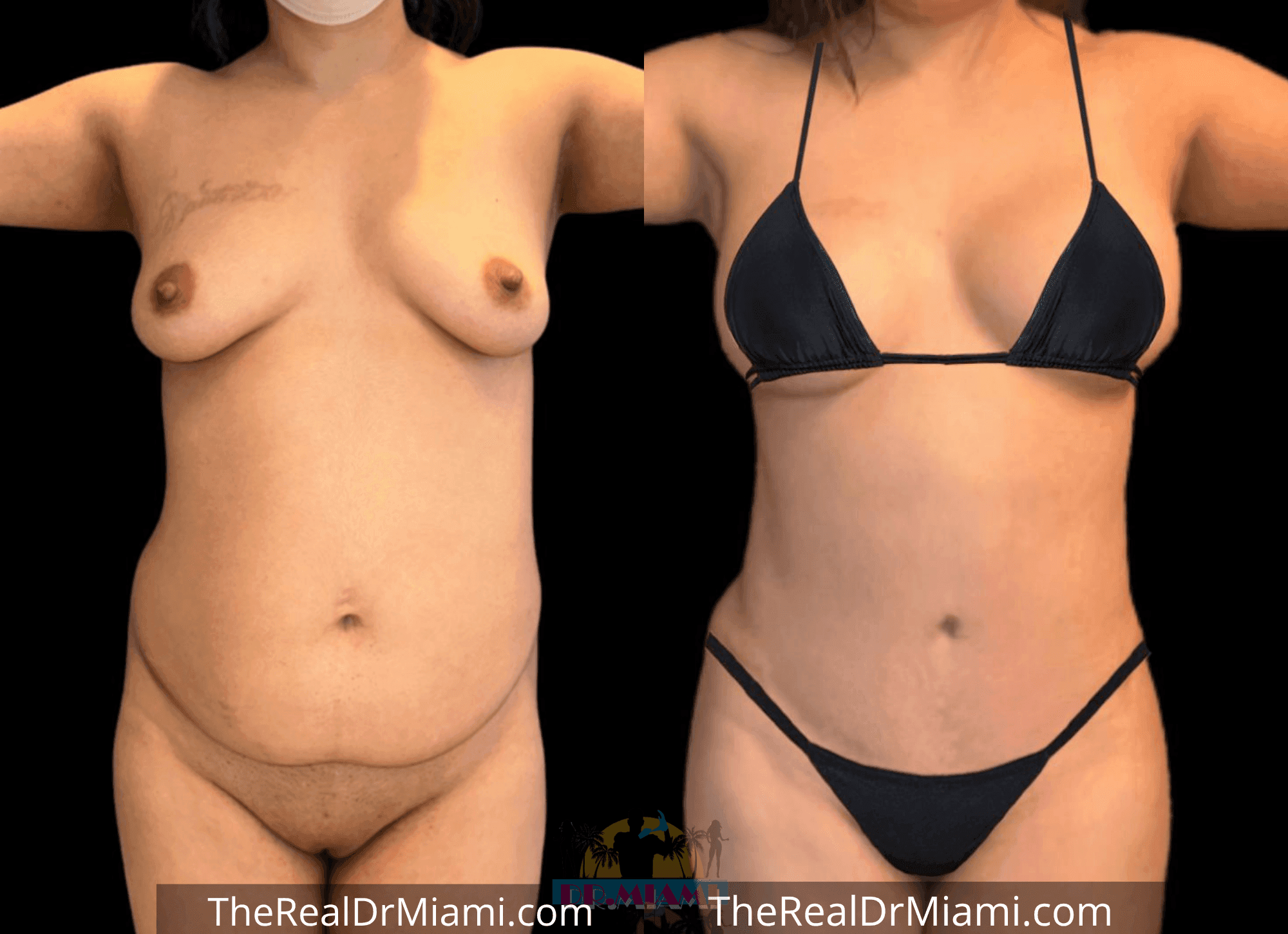 Before-and-after views for Tummy Tuck, Case 49.
