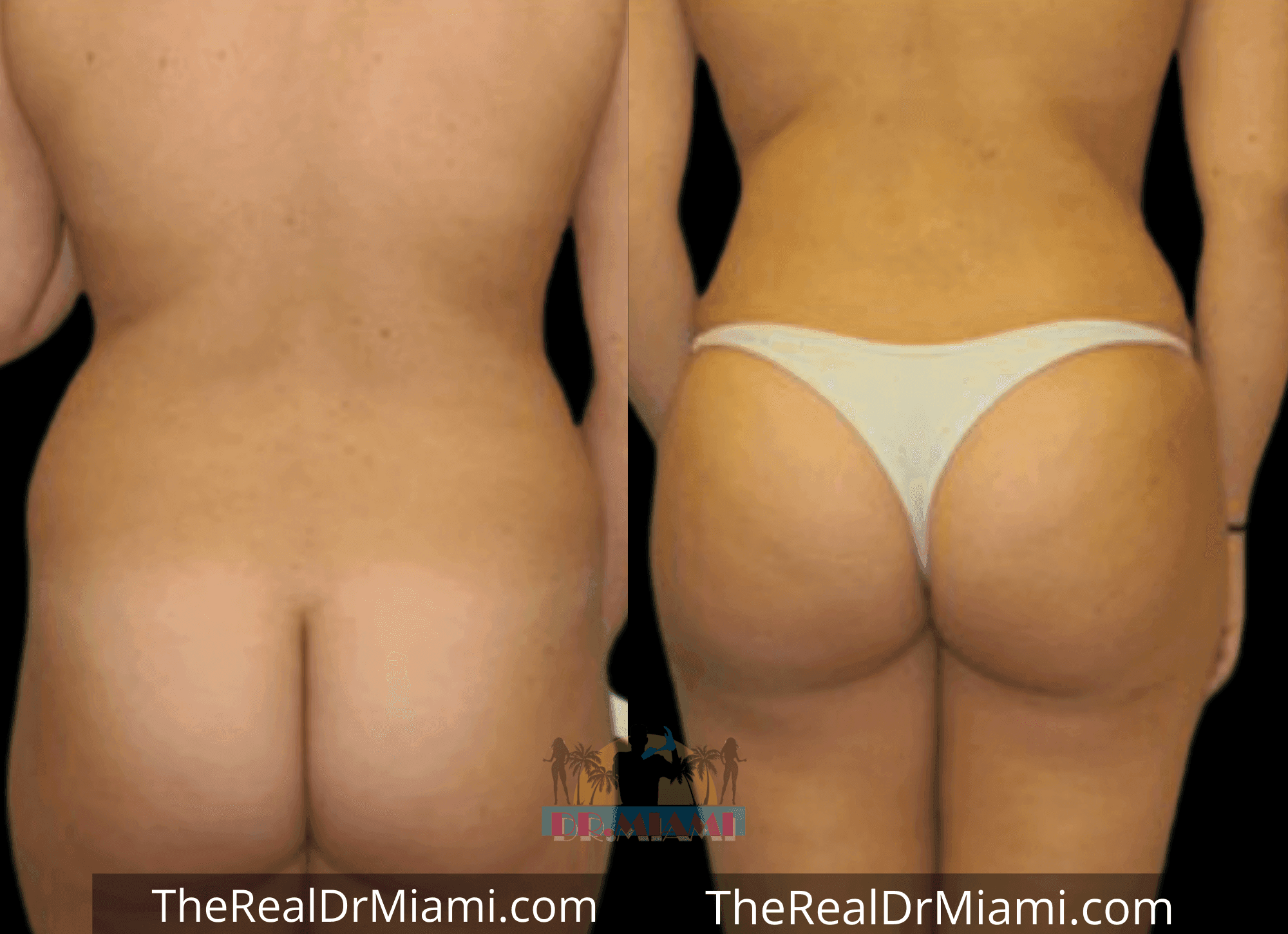 Before-and-after views for Brazilian Butt Lift, Case 67.