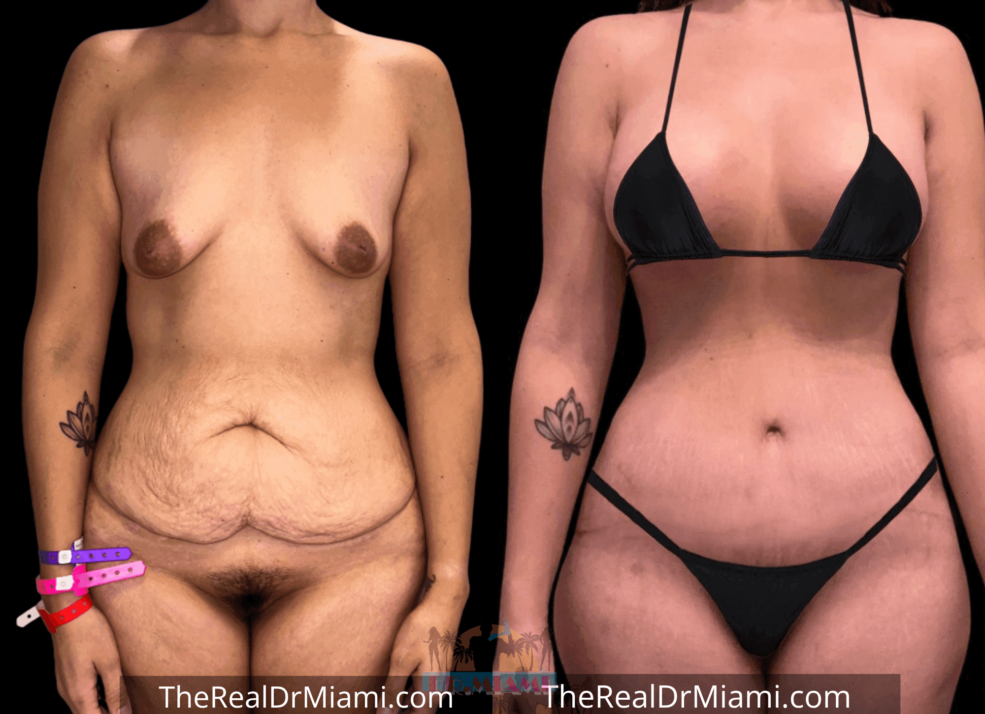 Before-and-after views for Tummy Tuck, Case 3.
