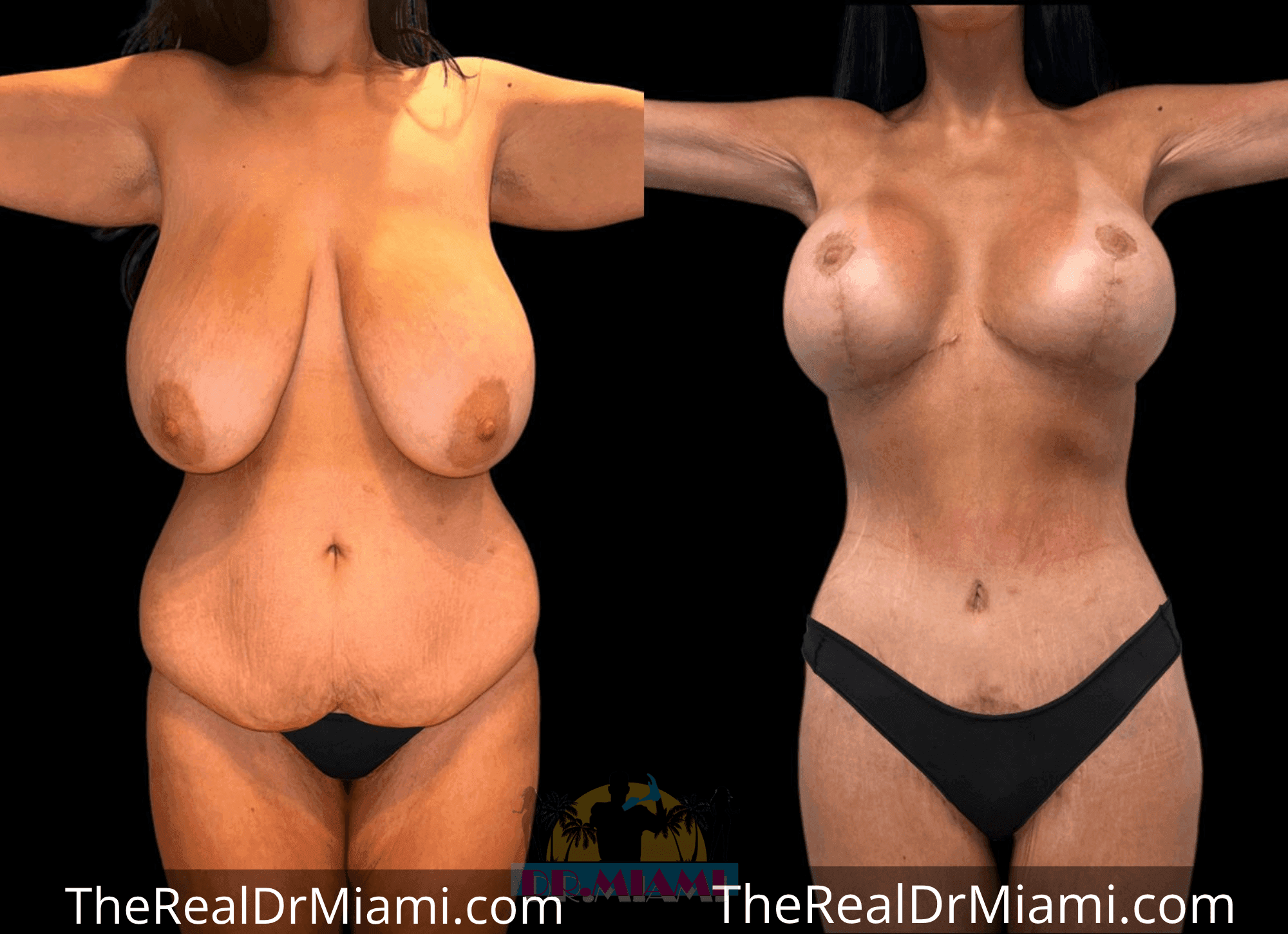 Before-and-after views for Massive Weight Loss, Case 22.