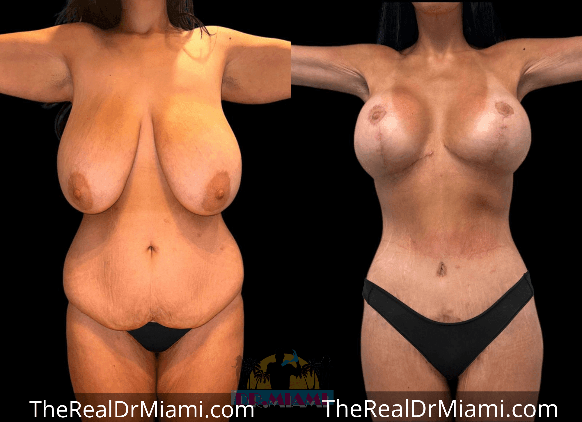 Before-and-after views for Massive Weight Loss, Case 22.